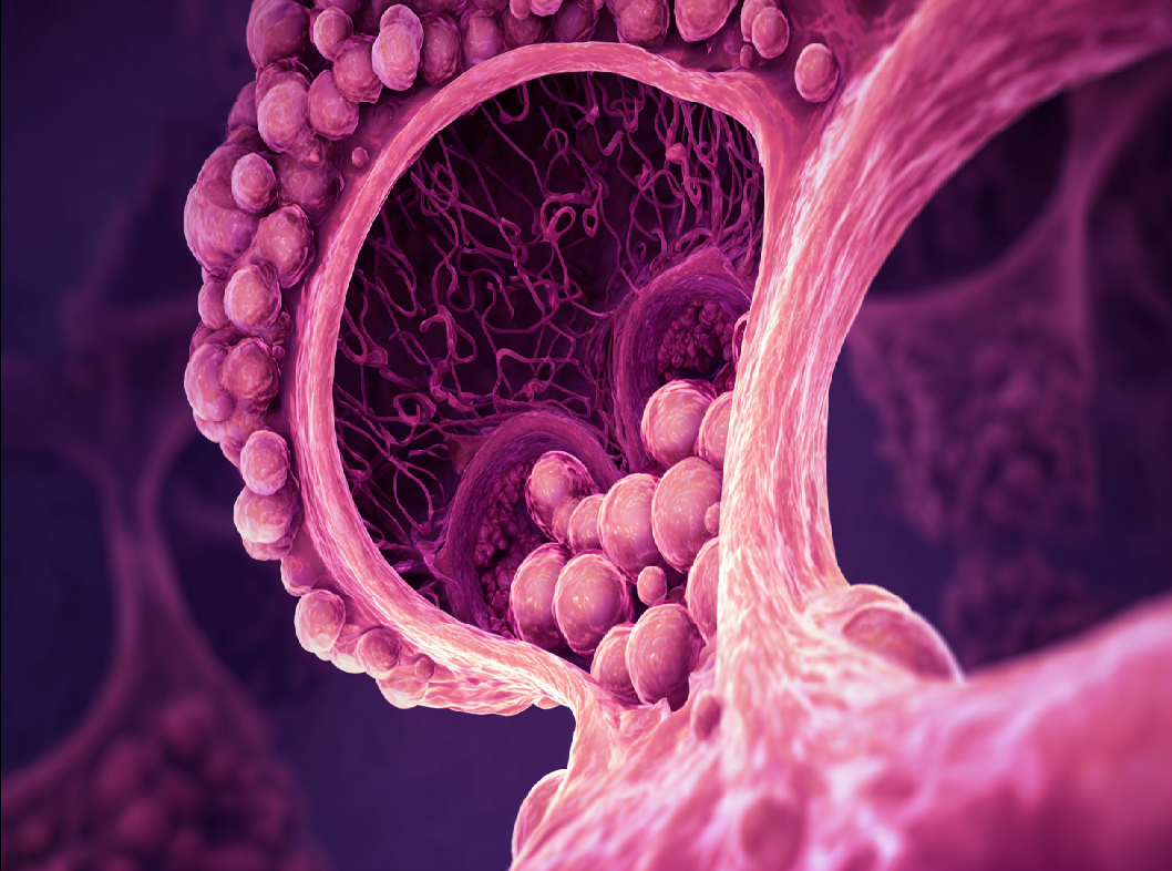 Субмукозная миома матки