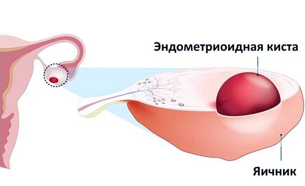 эндометриоидная киста