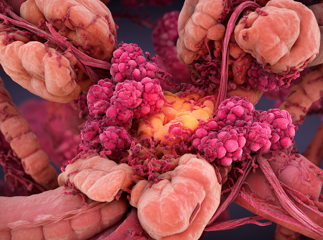 3D иллюстрация острого гонорейного пельвиоперитонита с воспаленными спайками и скоплением гнойного экссудата