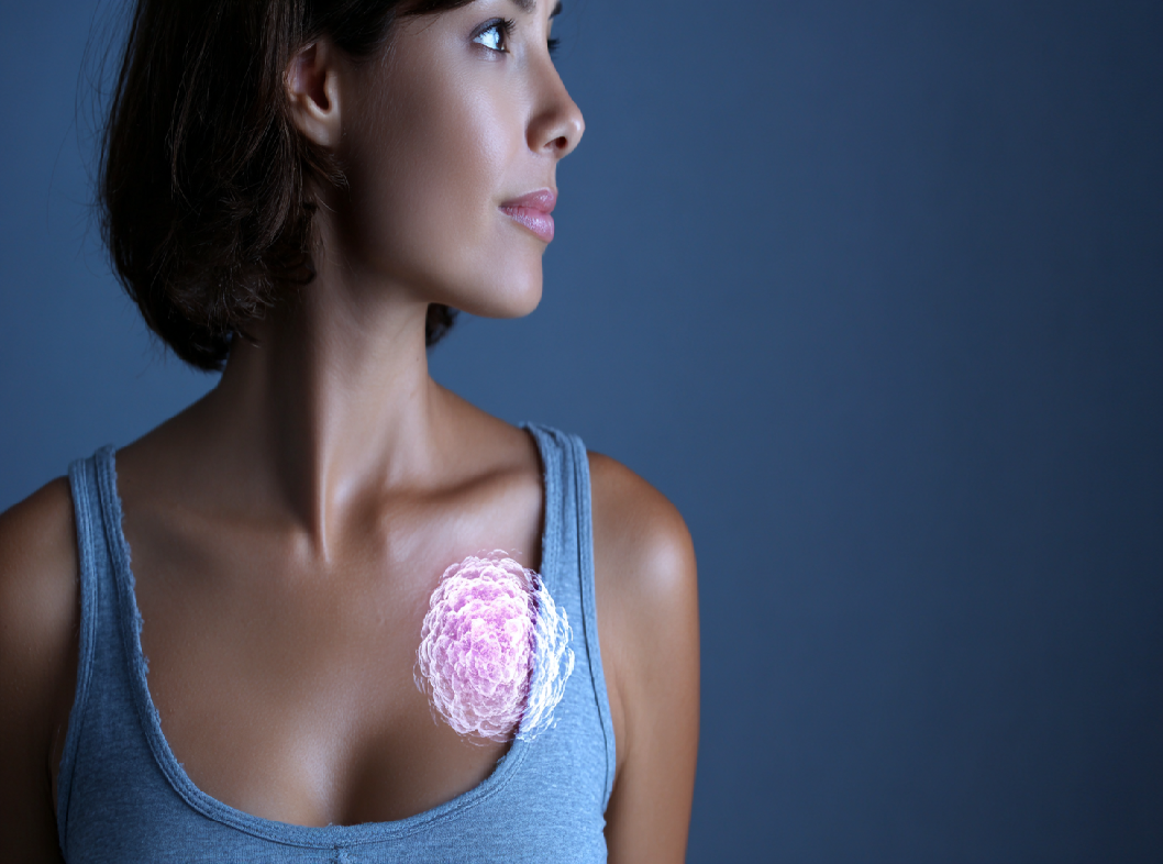 Основные отличия фиброаденомы от кисты молочной железы