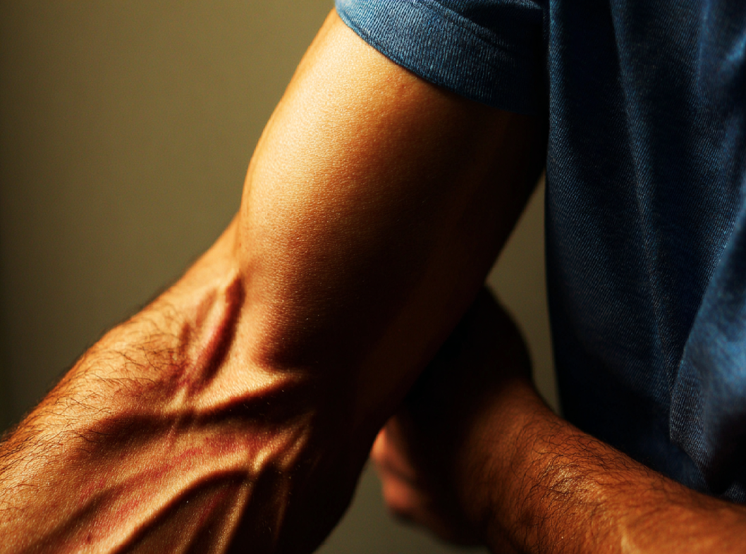 Что делать, если болят вены на руках и к кому обратиться?