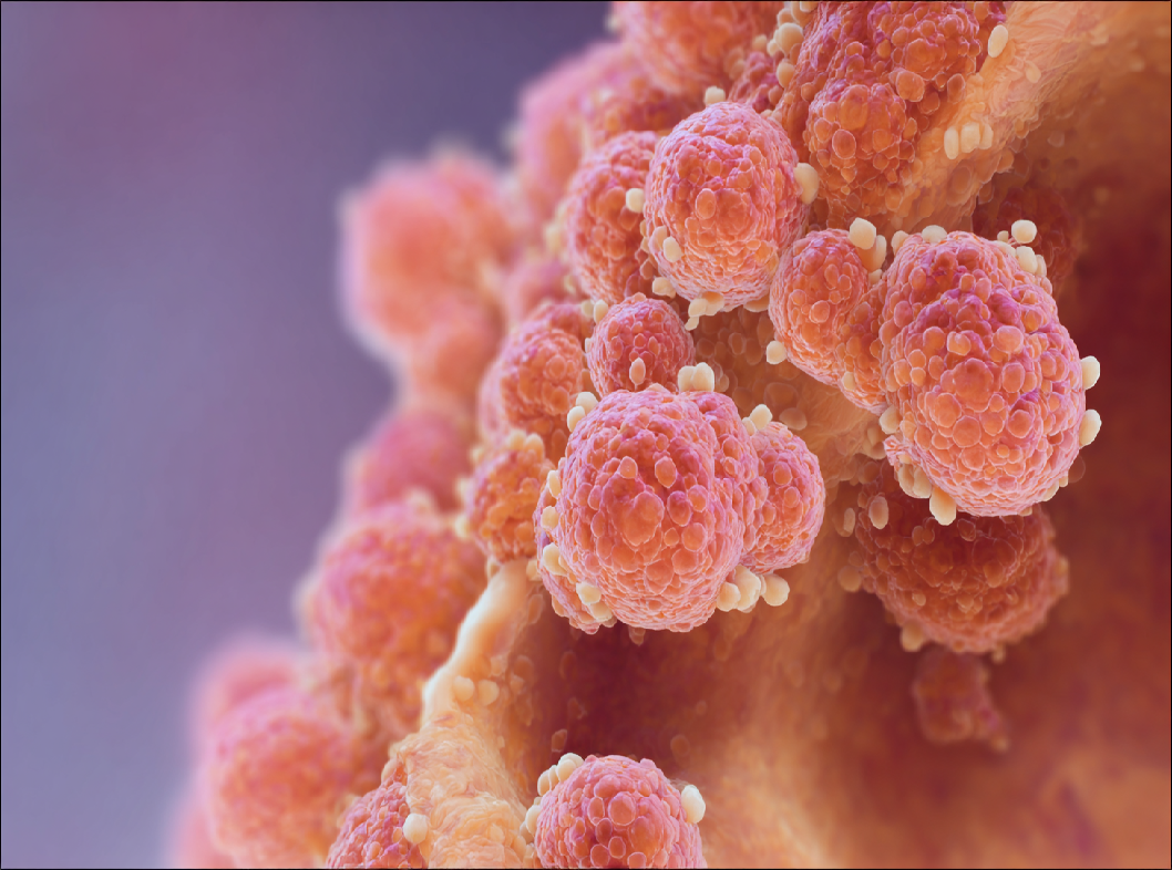 Железистый полип эндометрия