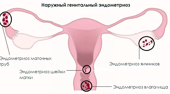 эндометриоз генитальный