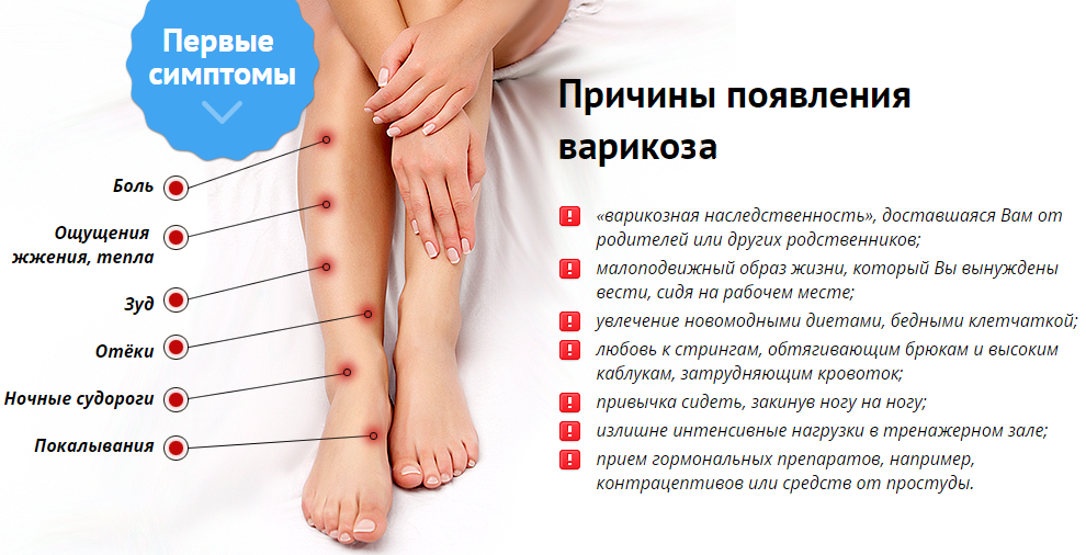 Причины варикоза ног