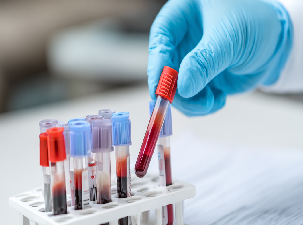Анализ крови на D-димер