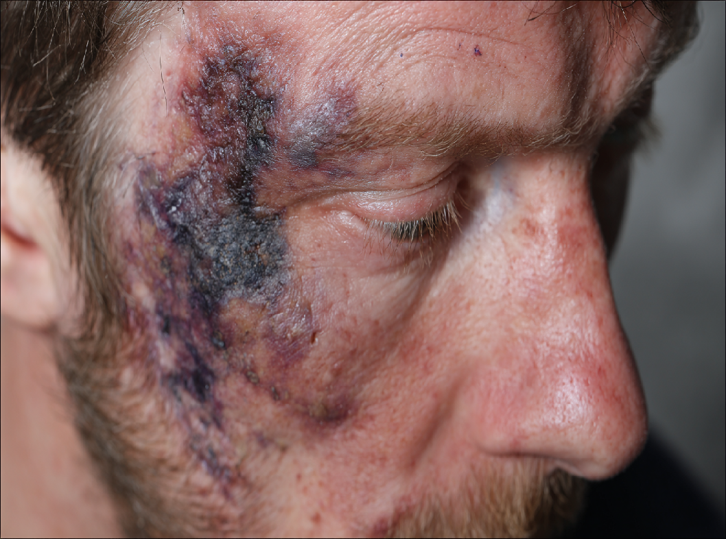 Помощь при ожогах