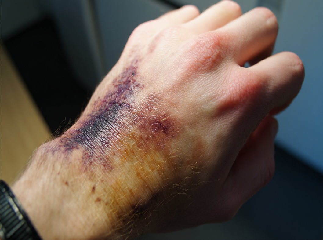 Помощь при ожогах