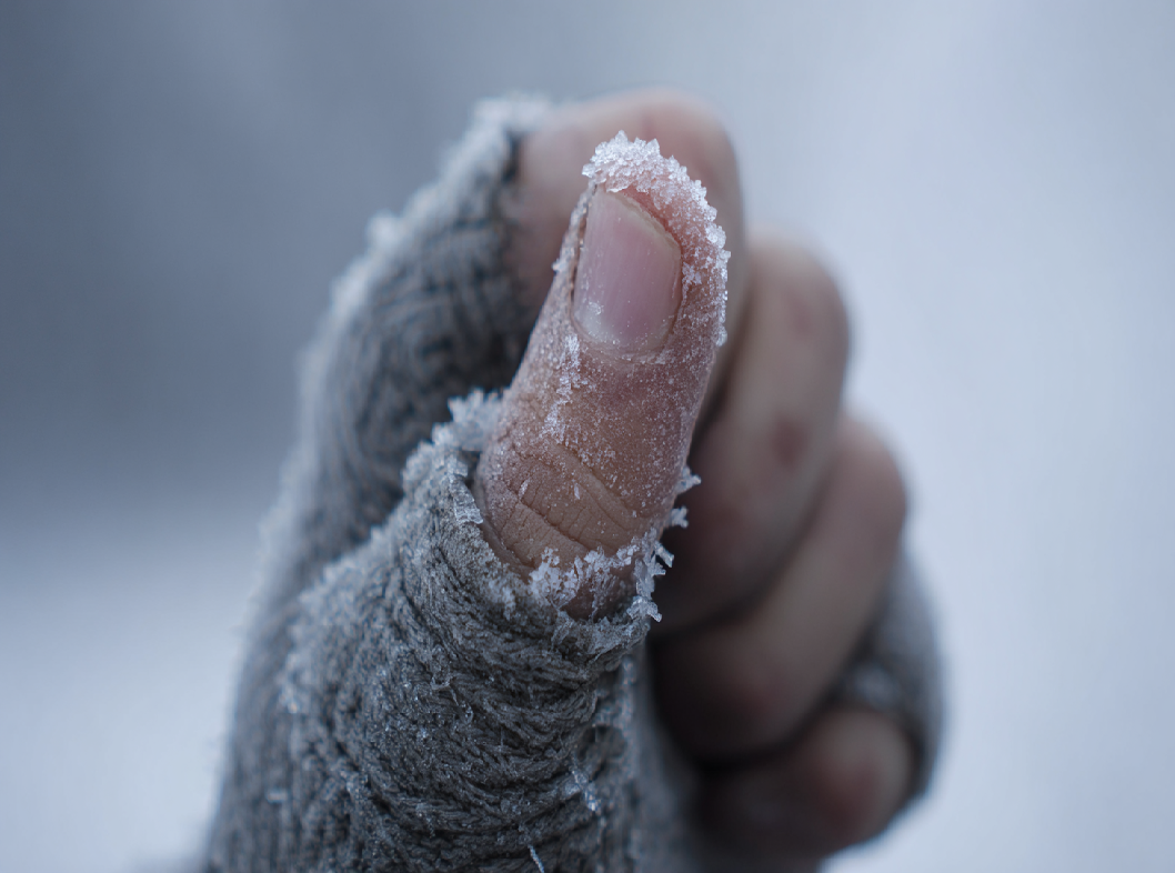 Обморожение пальцев рук