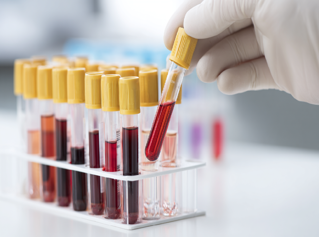 Анализ крови на холестерин