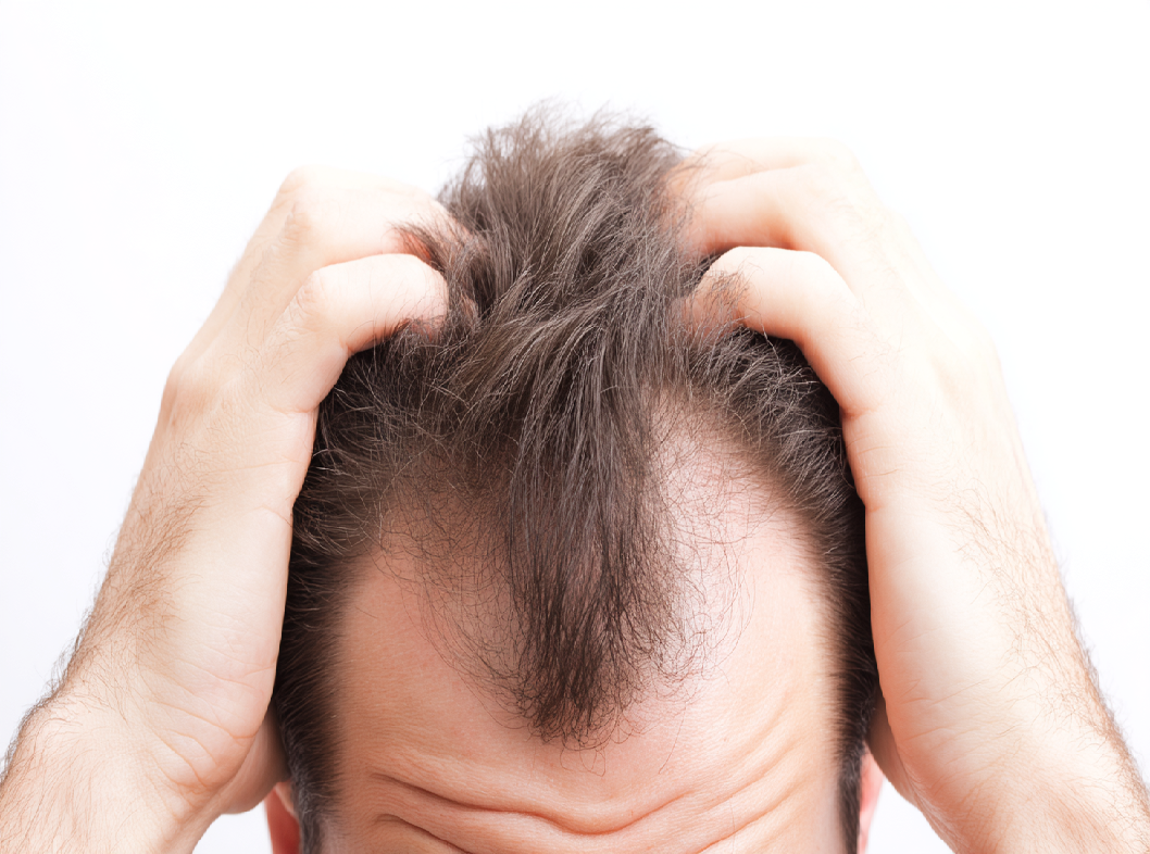 Анализы при выпадении волос