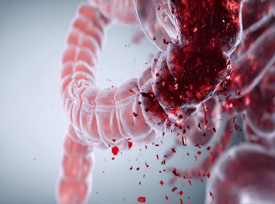 Желудочно-кишечные кровотечения