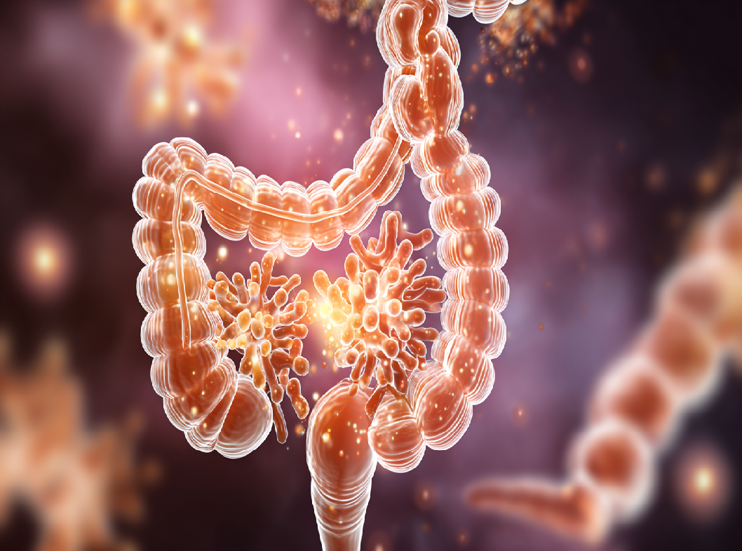 Предраковые состояния ЖКТ