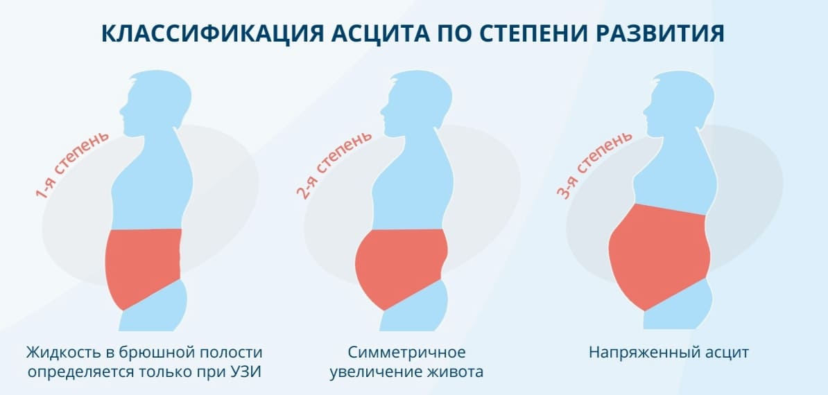 асцит