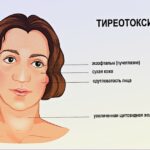 При каких болезнях есть тиреотоксикоз? Arimed