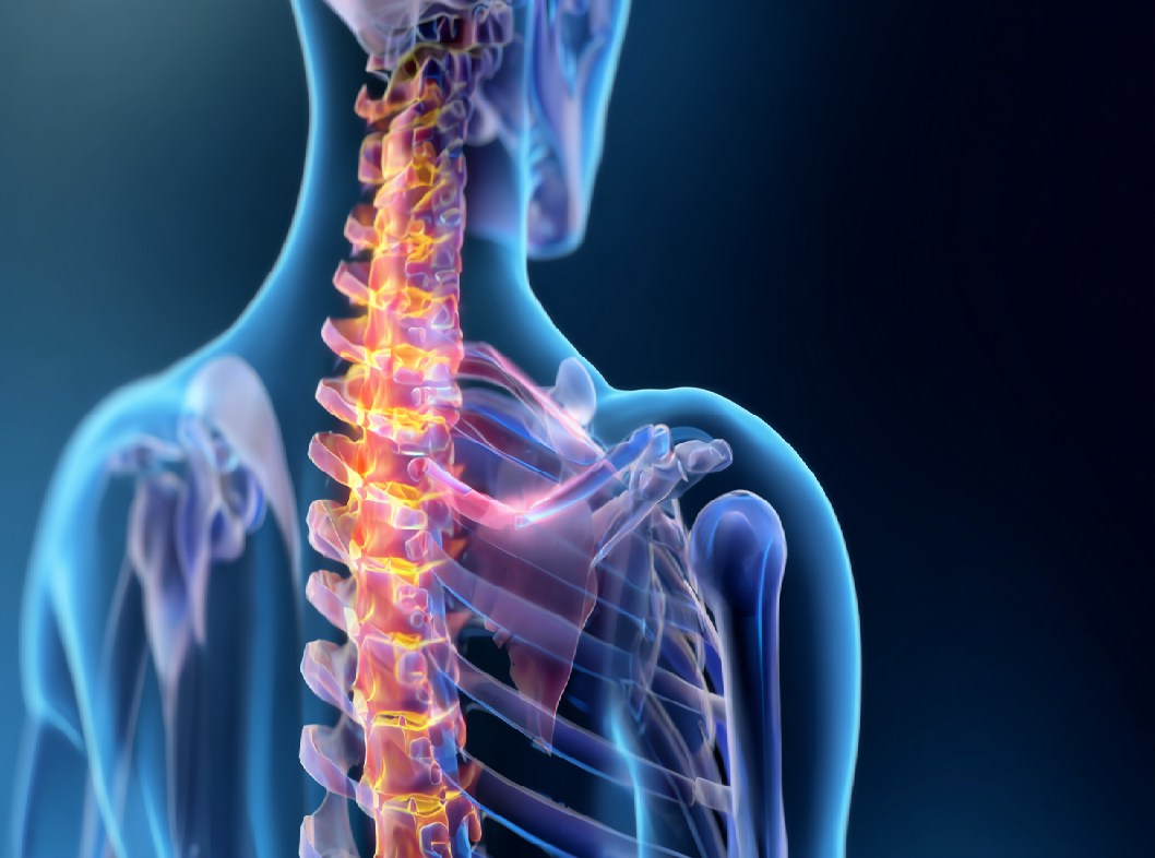 Остеопороз