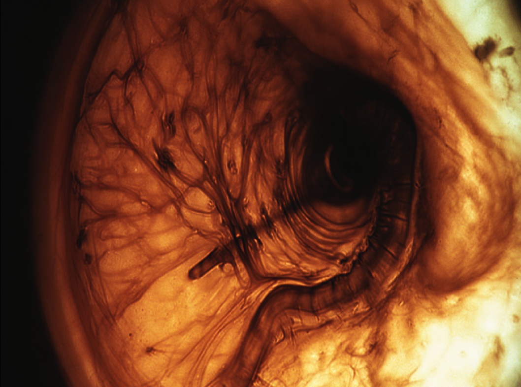 Недостаточность сфинктера Одди