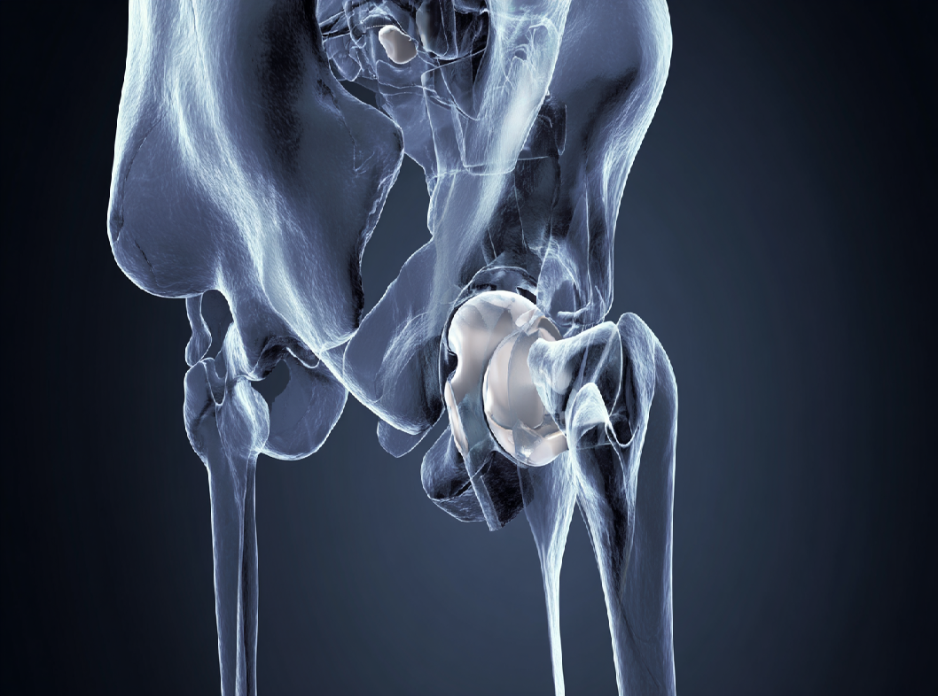 Вывих тазобедренного сустава