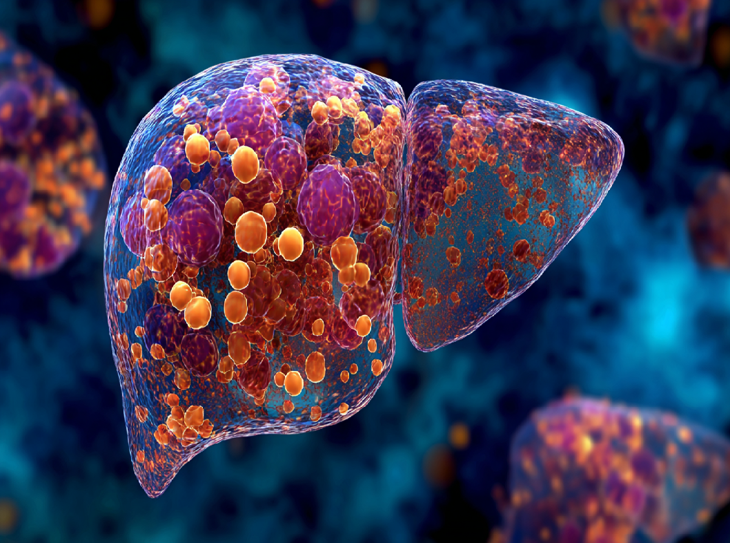 Жировой гепатоз