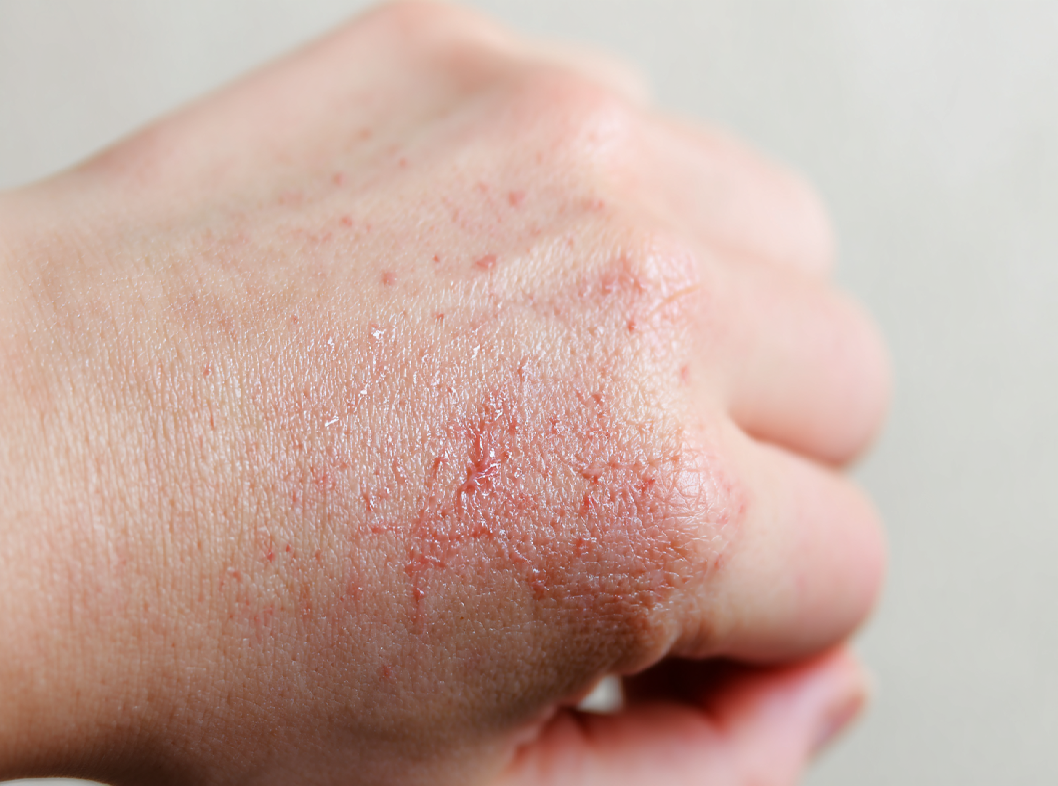 Контактный дерматит