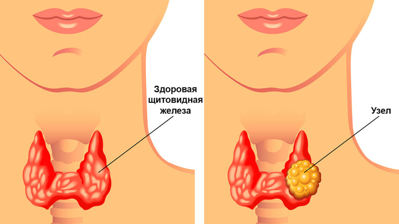 узлы щитовидной железы