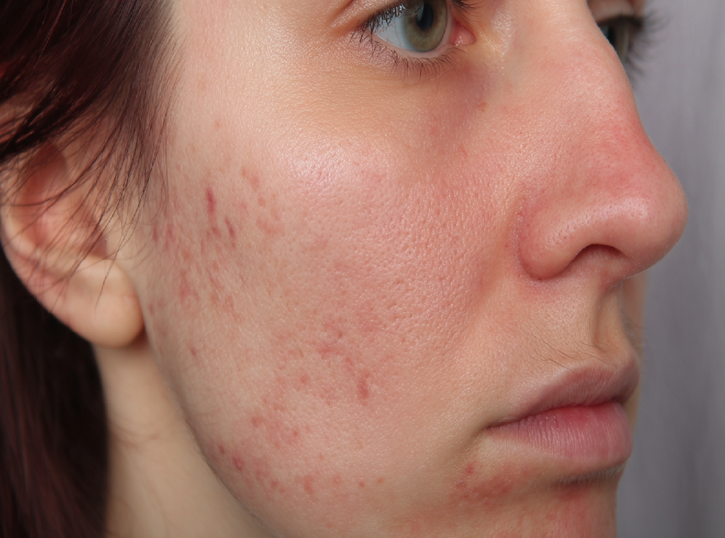 Токсикодермия