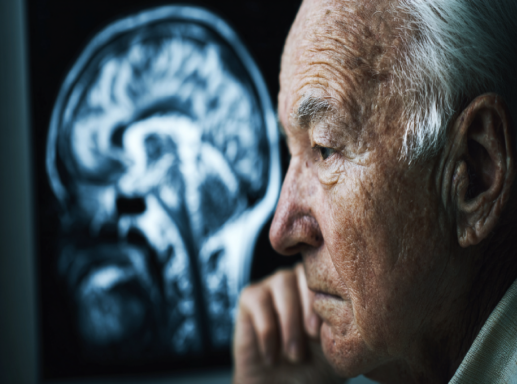 Болезнь Альцгеймера