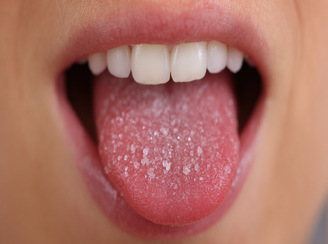 Белый налёт на языке