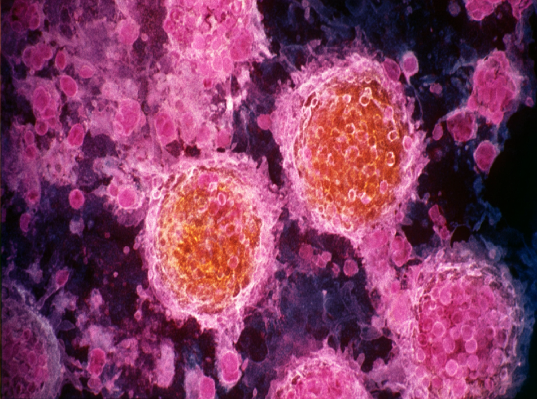 Лимфома Ходжкина