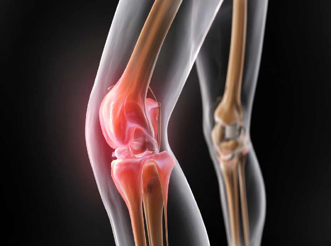 Вывих коленного сустава Arimed