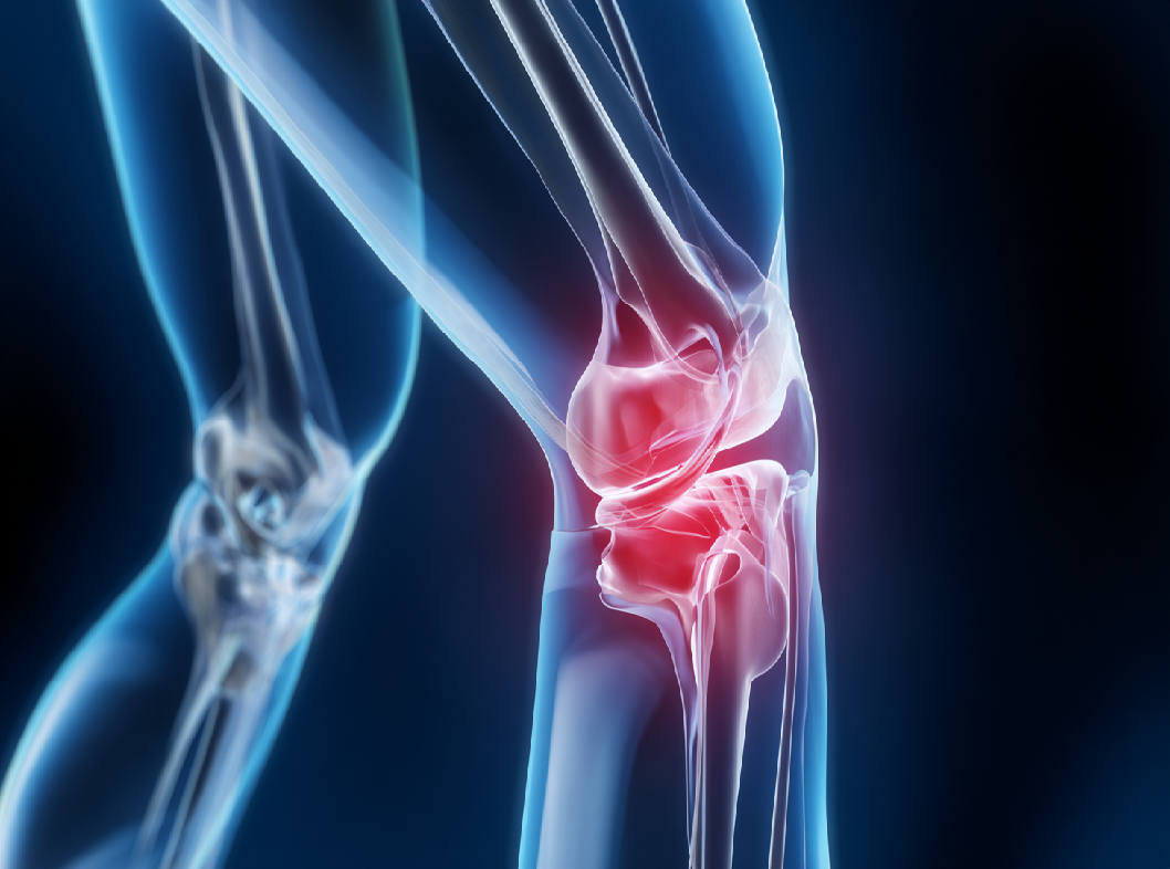 Вывих коленного сустава