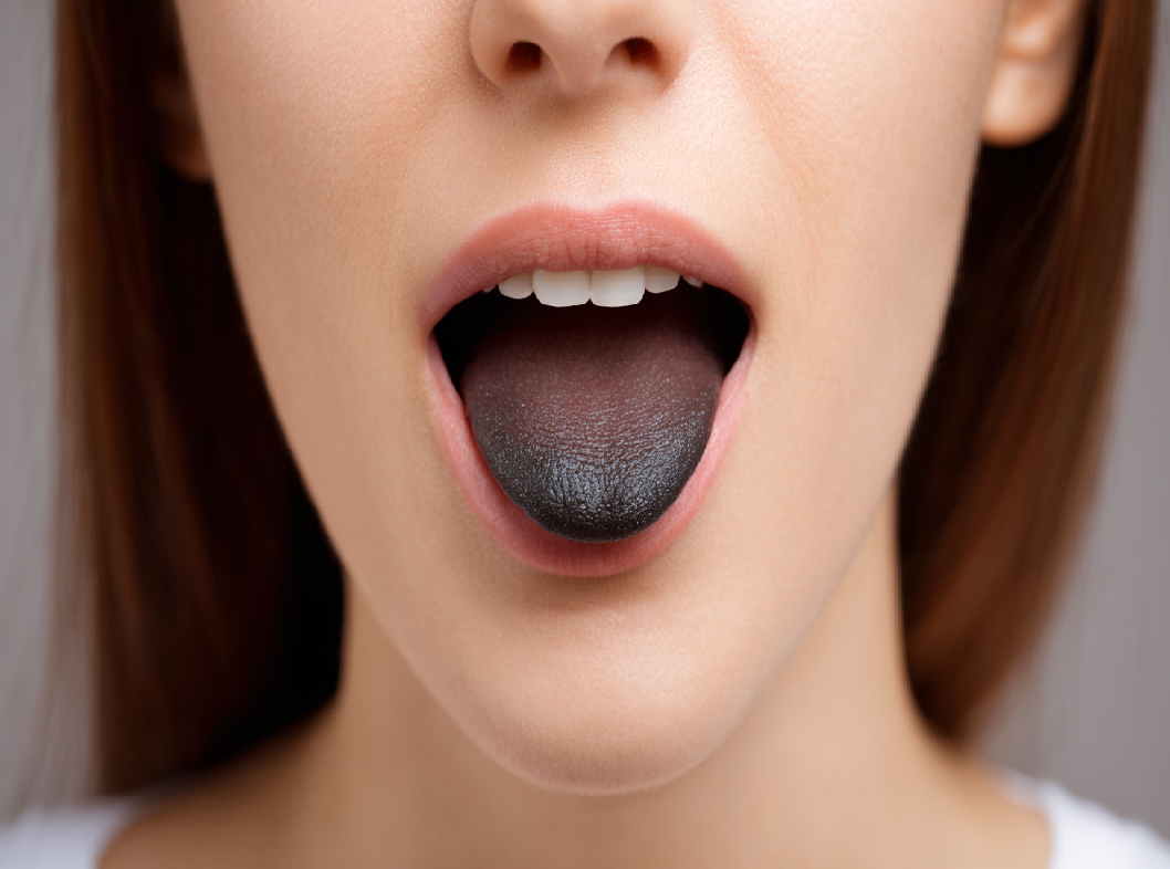 Черный язык, причины