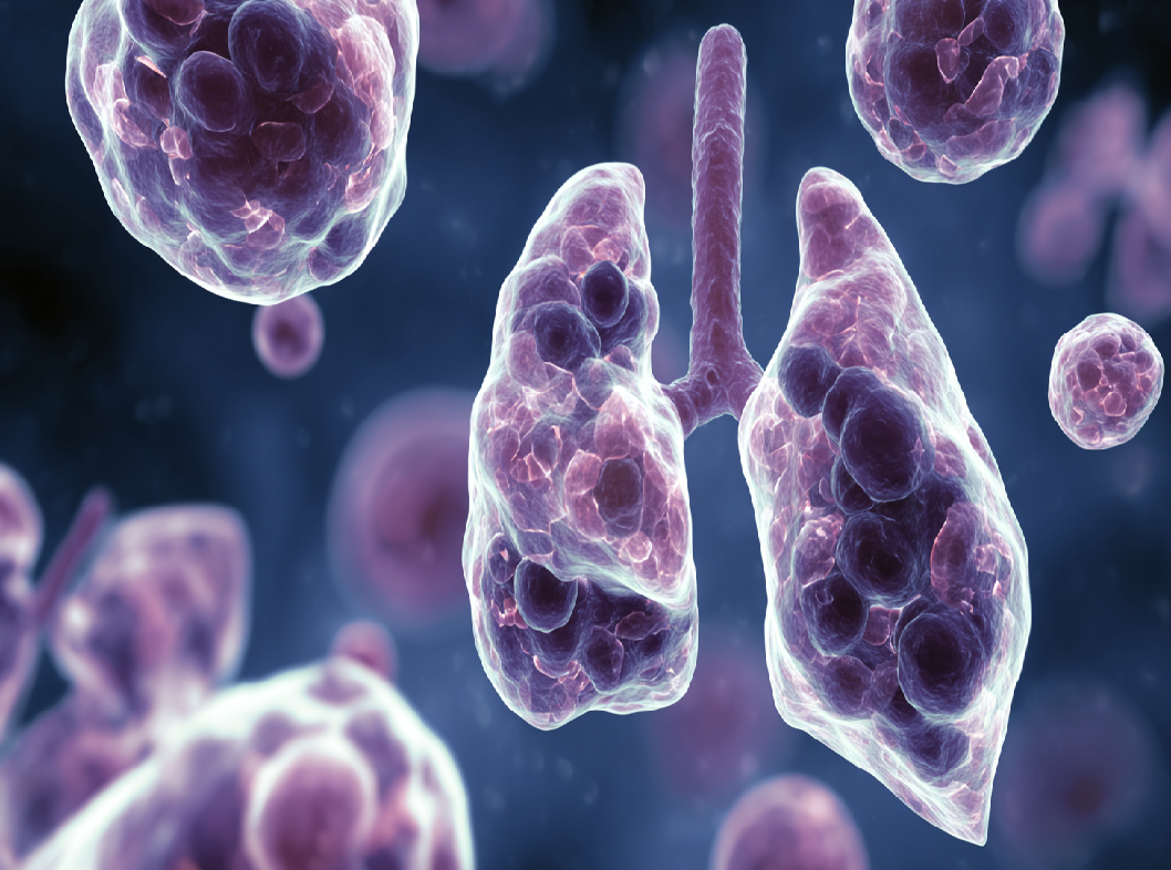 Микоплазменная пневмония