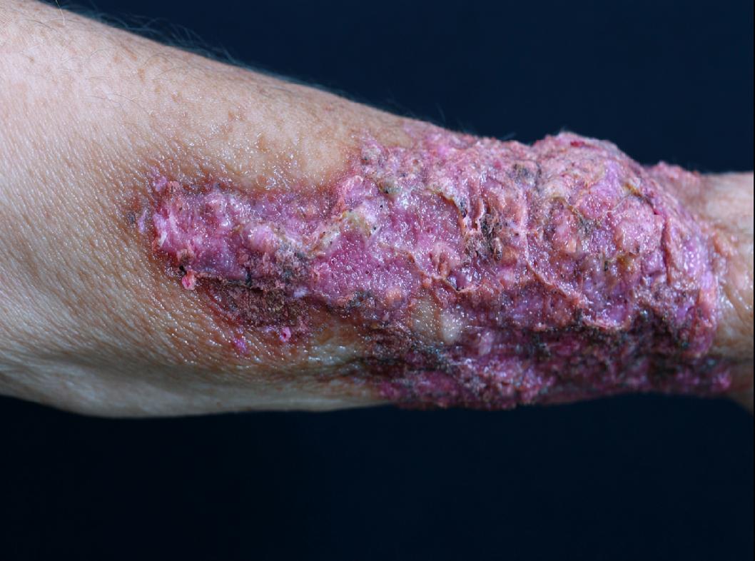 Саркома Капоши