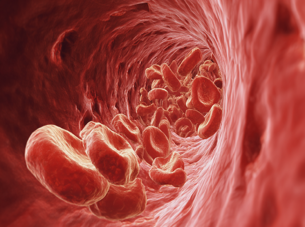 Атеросклероз