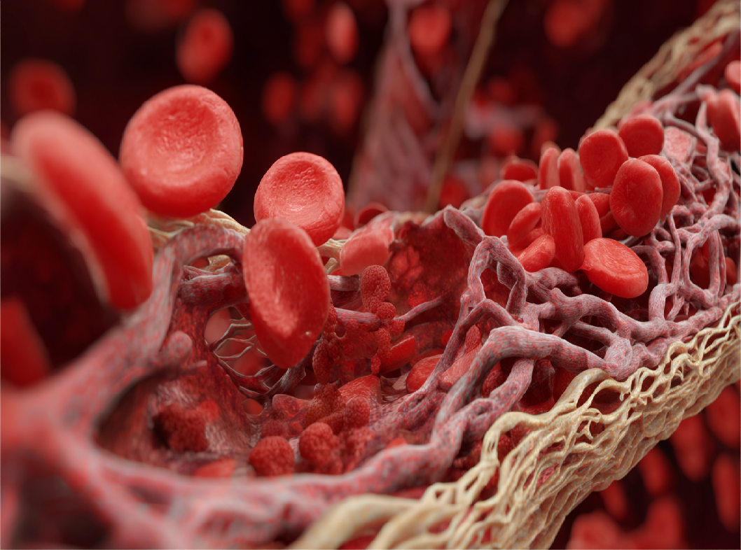 Атеросклероз