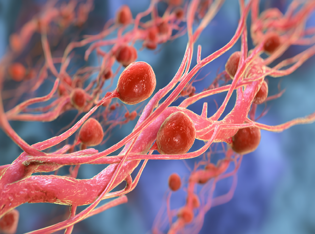 Болезнь Гоше