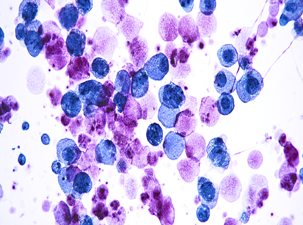 Почему важно сдавать жидкостную цитологию.