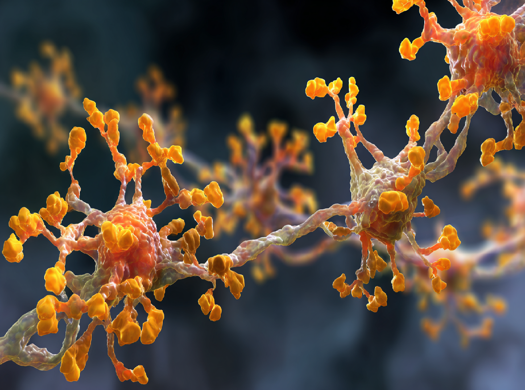 Болезнь Гоше