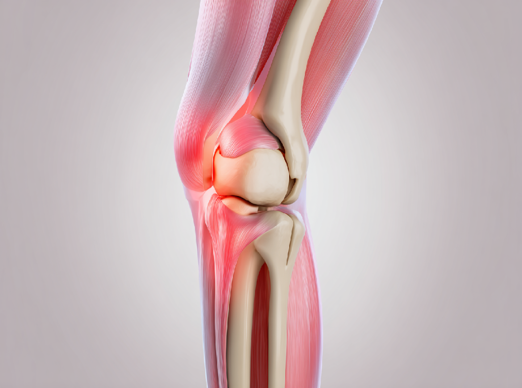 Артроз коленного сустава