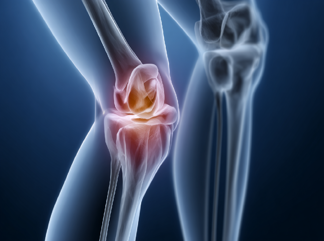 Артроз коленного сустава