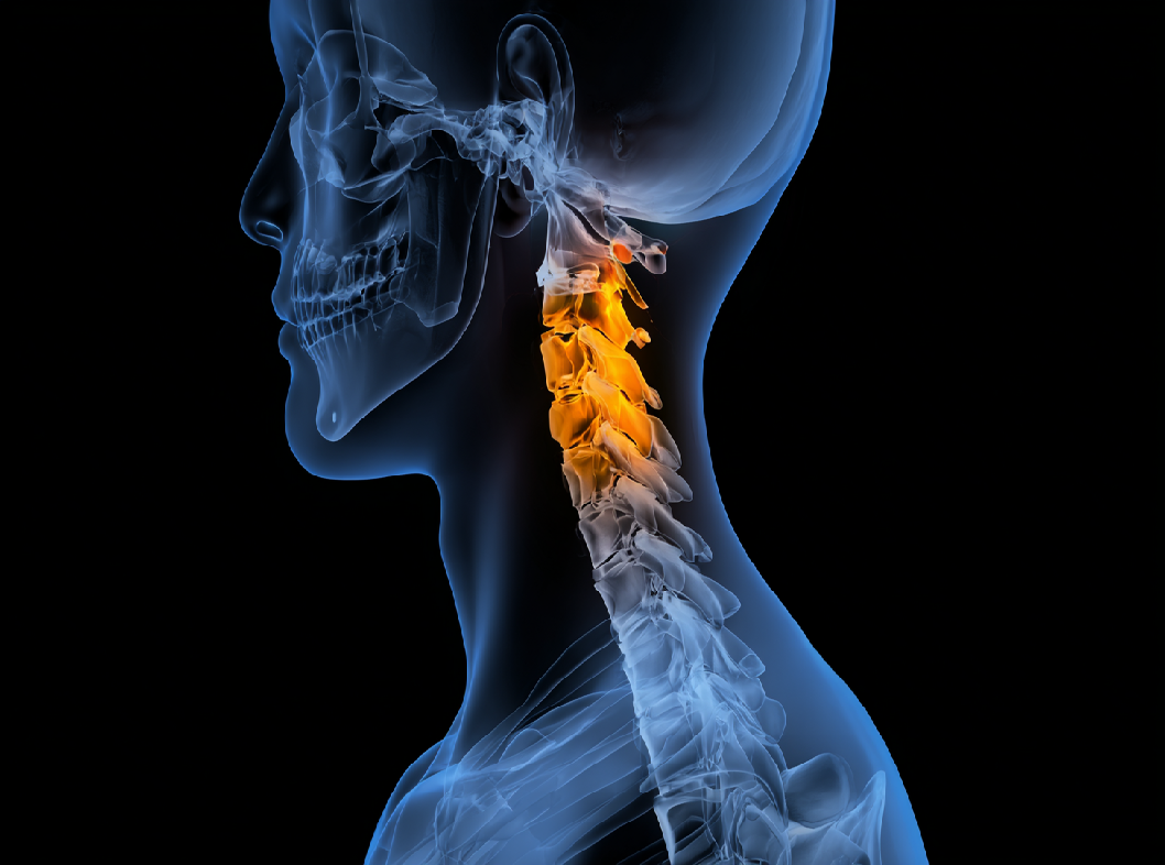 Шейный остеохондроз