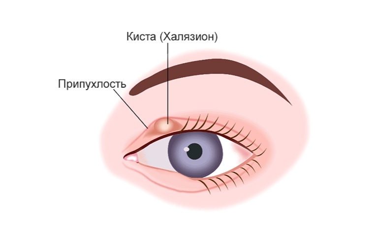 халязион