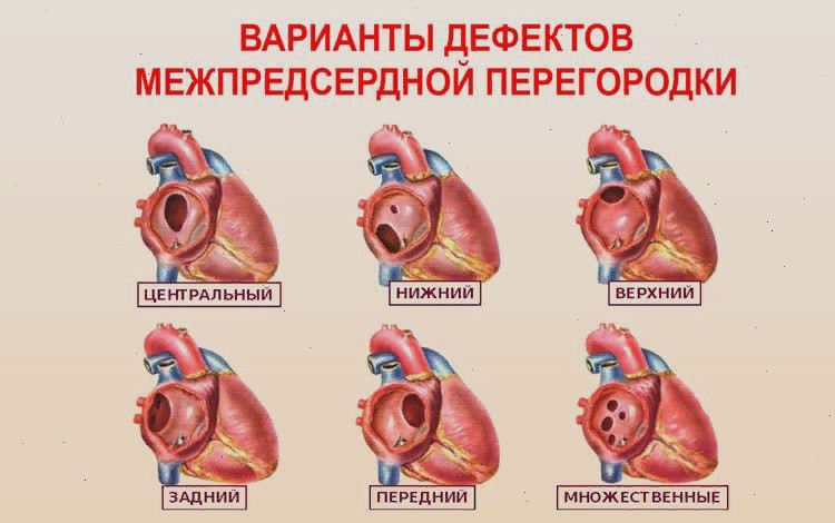 Врождённый порок сердца