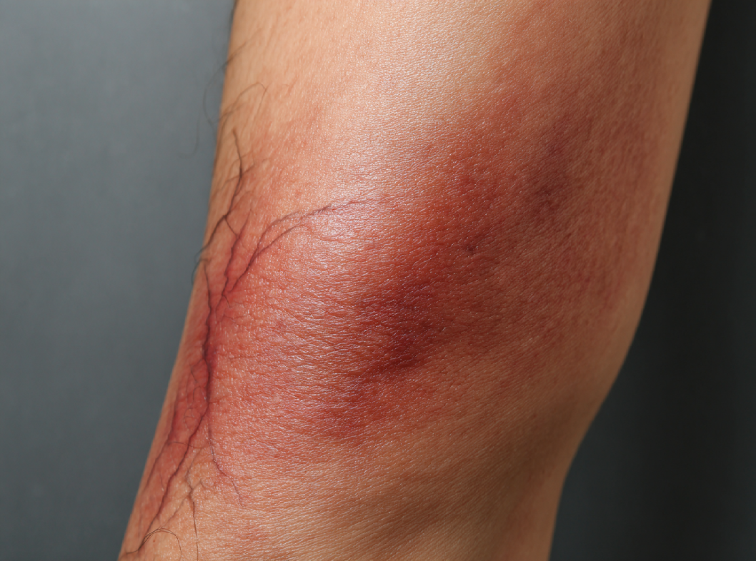 Тромбофлебит