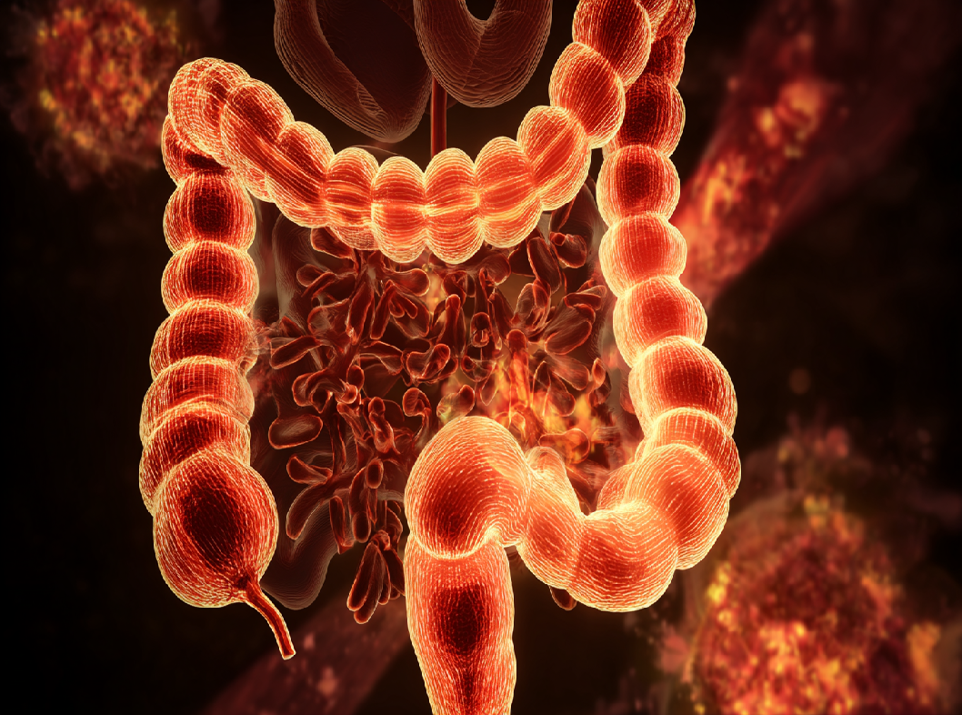 Дивертикулит