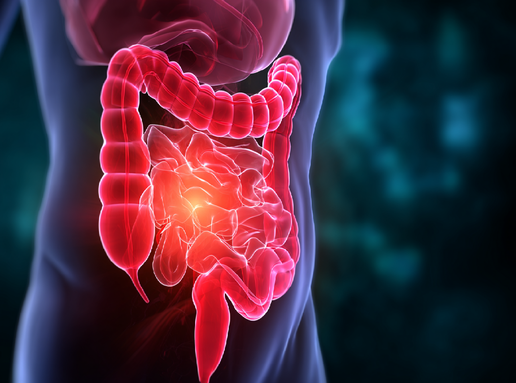 Дивертикулит