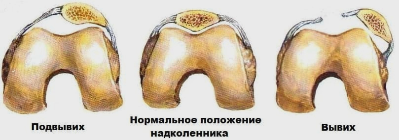вывих коленного сустава