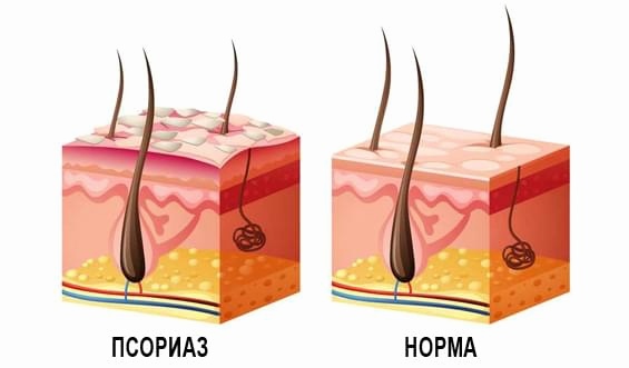 псориаз
