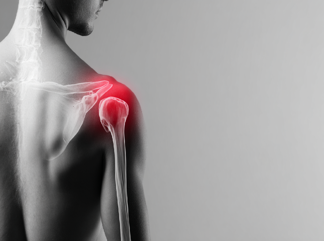 Вывих плечевого сустава Arimed