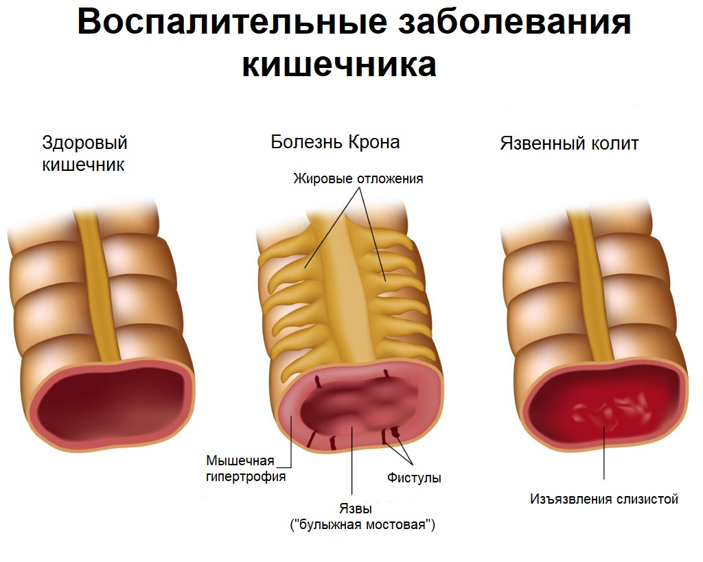 заболевания кишечника